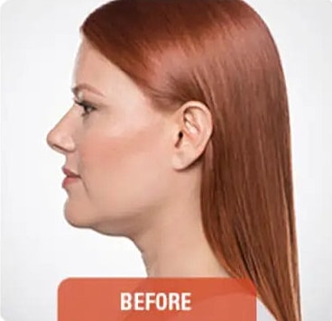 Kybella Before & After