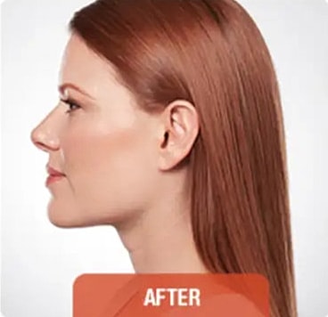 Kybella Before & After