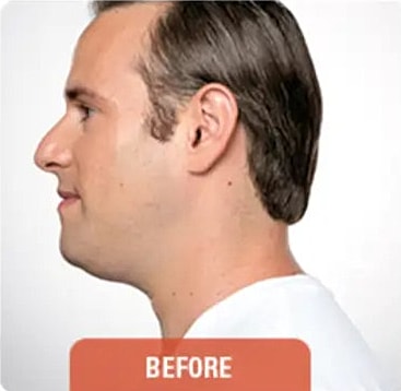 Kybella Before & After