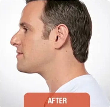 Kybella Before & After