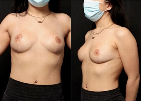 Breast Reduction Before & After