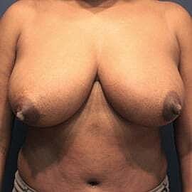 Breast Reduction Before & After