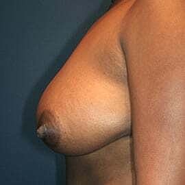 Breast Reduction Before & After