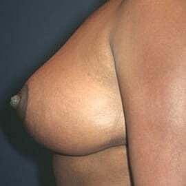 Breast Reduction Before & After