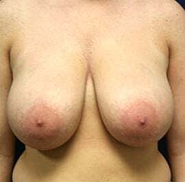 Breast Reduction Before & After