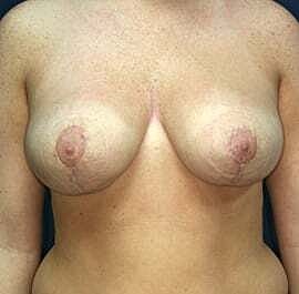 Breast Reduction Before & After
