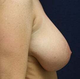 Breast Reduction Before & After