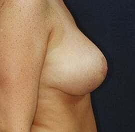 Breast Reduction Before & After