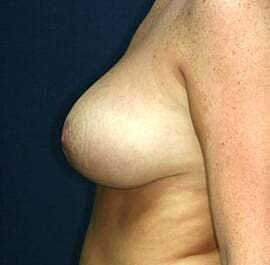 Breast Reduction Before & After