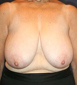 Breast Reduction Before & After