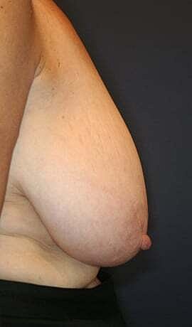 Breast Reduction Before & After