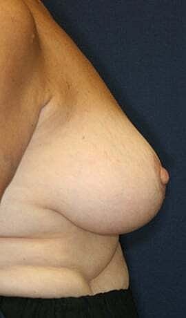 Breast Reduction Before & After