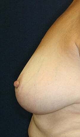 Breast Reduction Before & After