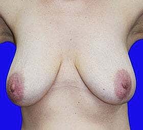 Breast Reduction Before & After