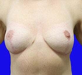 Breast Reduction Before & After