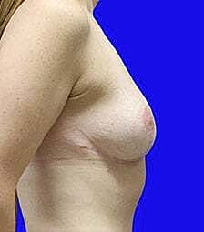 Breast Reduction Before & After