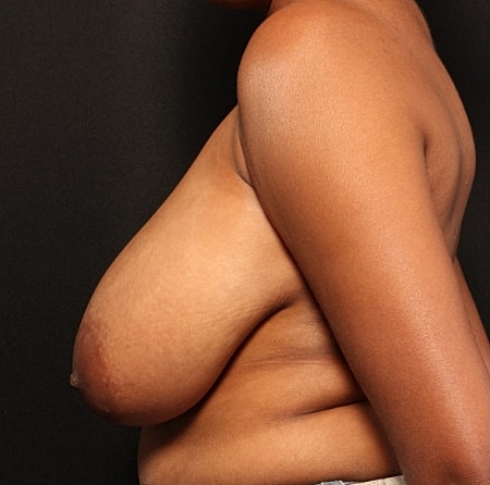Breast Reduction Before & After