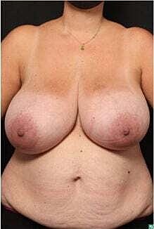 Breast Reconstruction Before & After