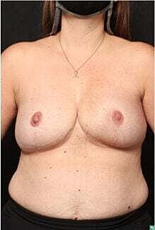 Breast Reconstruction Before & After