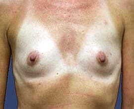 Breast Reconstruction Before & After