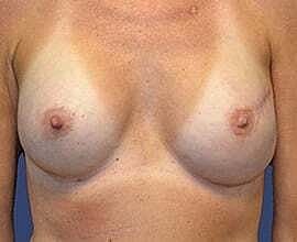 Breast Reconstruction Before & After