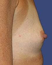 Breast Reconstruction Before & After