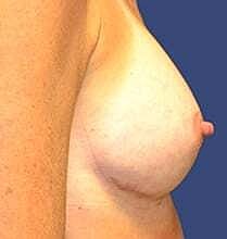 Breast Reconstruction Before & After