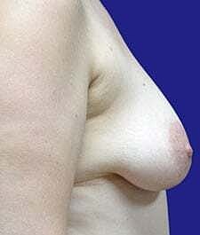 Breast Reconstruction Before & After