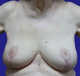 Breast Reconstruction Before & After