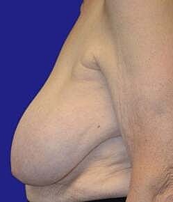Breast Reconstruction Before & After