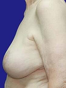 Breast Reconstruction Before & After