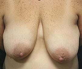 Breast Reconstruction Before & After