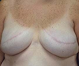 Breast Reconstruction Before & After