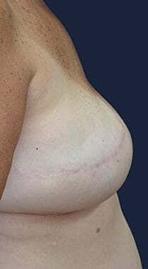 Breast Reconstruction Before & After
