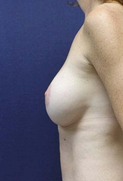 Breast Reconstruction Before & After