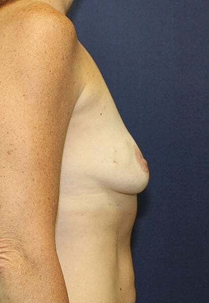 Breast Reconstruction Before & After
