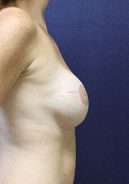 Breast Reconstruction Before & After