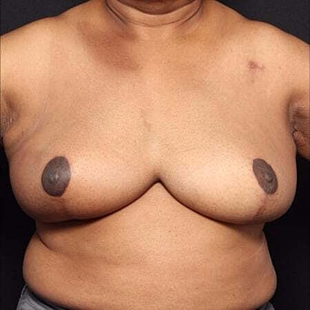 Breast Reconstruction Before & After