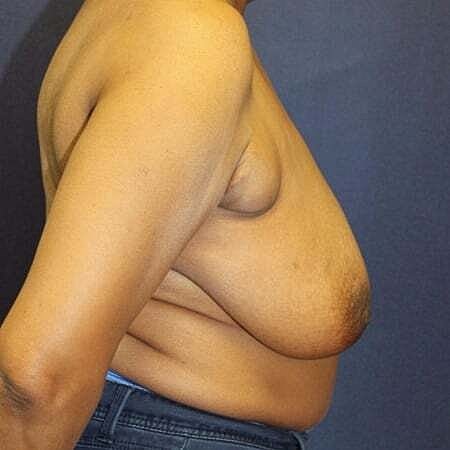 Breast Reconstruction Before & After
