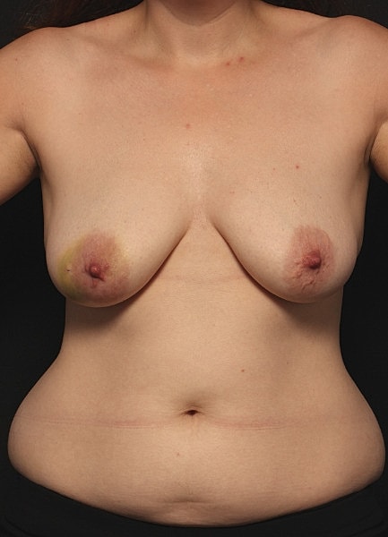 Breast Reconstruction Before & After