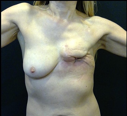 Breast Reconstruction Before & After