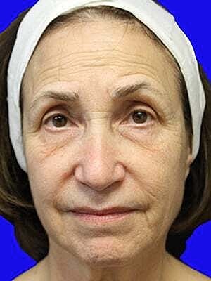 Facelift Before & After