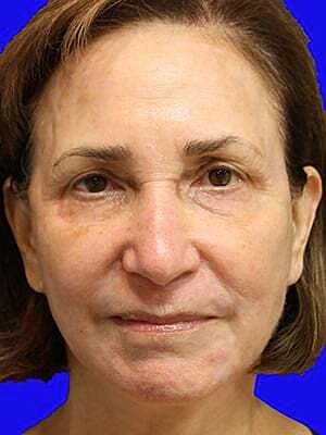 Facelift Before & After