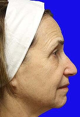 Facelift Before & After
