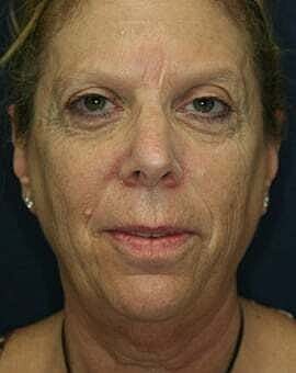 Facelift Before & After