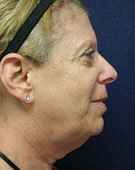 Facelift Before & After