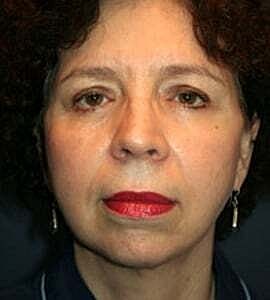 Facelift Before & After