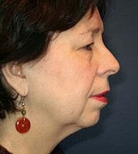 Facelift Before & After