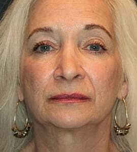 Facelift Before & After