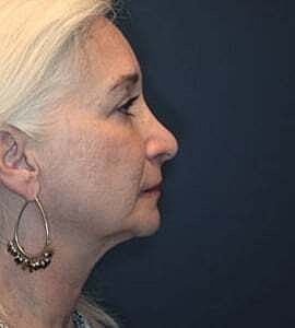 Facelift Before & After